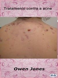 Tratamento Contra A Acne